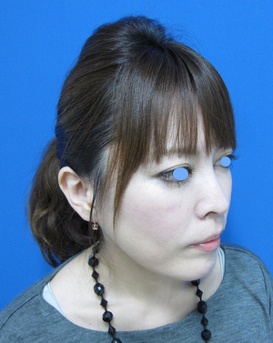 目の下のたるみ、目のくまでお悩みの方、切らずに完璧に解決します。TCB-R法　手術直後　症例写真